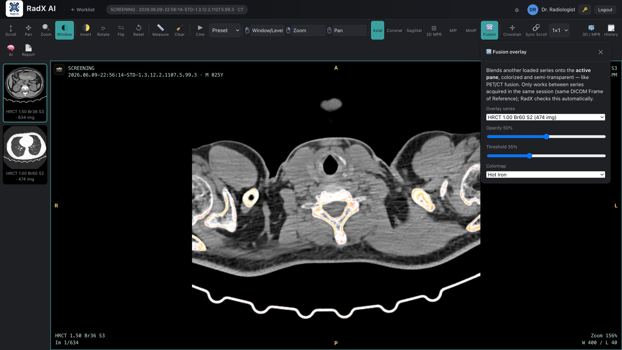 RadX AI viewer with colorized fusion overlay